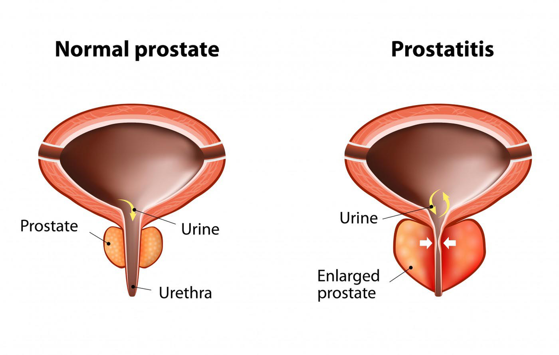 Нормальная простата здорового мужчины и воспаление простаты при простатите