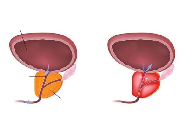 нормальная и воспаленная простата